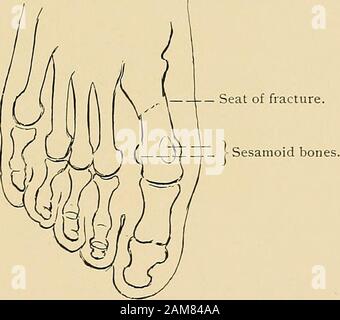 Le traitement des fractures . Fig. 565.-métatarse et phalanges, montrant l'épiphyse à quinze ans (Warren Museum, modèle 537).. Fig. 566.-Fracture du premier métatarsien du pied droit (X-ray tracing Fracture du métatarse (voir Fig. 565).-Ce frac-ture est causée par la violence directe. La première et cinquième os sont les plus souvent cassés (voir Fig. 566). Les symptômes, la douleur, l'areswelling crépitation et d'anomalies de la mobilité. Le poids ne peut pas être à la charge sur le pied sans douleur. Il n'y a jamais de greatdisplacement. Afin d'éviter les ennuis en unionhas à pied après avoir eu lieu, il n'est Banque D'Images