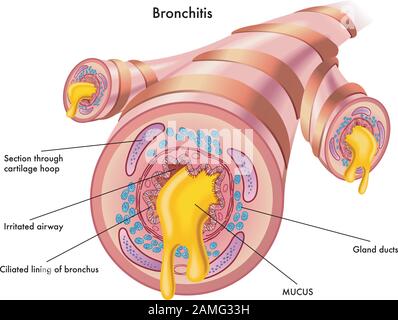 Illustration médicale des effets de la bronchite. Illustration de Vecteur