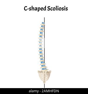 Scoliose en forme de C. Dextroscoliose. Lévocolisose. Courbure rachidienne, kyphose, lordose, scoliose, arthrose. Infographies. Illustration vectorielle activée Illustration de Vecteur