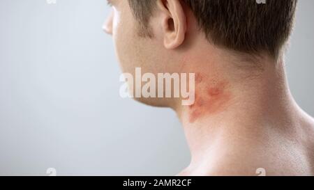 Taches rouges sur le cou du patient masculin, morsures d'insectes, allergie, dermatite de contact Banque D'Images