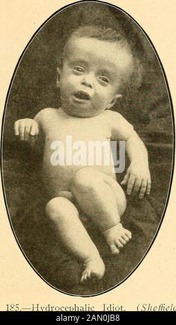 Diagnostic et traitement modernes des maladies de l'enfant; un traité sur les maladies médicales et chirurgicales de l'enfance anf . cy. L'idiot mongol est une créature restlesscréature. Totalement idiotique au début de l'enfance, il signe peu à peu d'amélioration de la mentalité. Il apprend à apprécier ses sondages sur-sondages, et à se faire comprendre par une langue d'hisown. Il apprend à courir à un âge plus précoce que la plupart des idiots d'othercretine, et ne montre pas rarement des tendances destructrices. Sous la poursuite- dans iprevs J sous traitement d'ajjjjie les crétines atteignent souvent une juste mesure de traitement intellectuel de la thyroïde; develo Banque D'Images