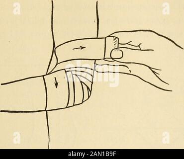 Le conseiller médical à domicile, un travail populaire sur le traitement de la maladie . Fig. 32.—Bandage de Gauntset, Montrant l'achèvement du Bandage de OneFinger. Commencez par faire quelques tours circulaires du bandage sur le poignet et puis l'amener sur le dos de la main, entourez le doigt et retournez comme indiqué par la flèche et faites un autre tour complet sur le poignet et commencez comme avant. BANDAGES 99. Fig. 33.—Figure sur huit du coude. L'application est commencée en faisant des virages circulaires separalcomplets du bandage autour du coude avec le centre du bandagesur le coude dans le coude, à l'avant, et ove Banque D'Images