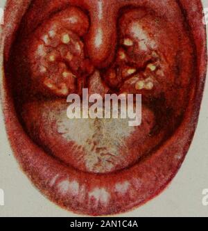 Maladies des enfants, pour les infirmières, y compris l'alimentation des nourrissons, les mesures thérapeutiques employées dans l'enfance, le traitement des urgences, la prophylaxie, l'hygiène et les soins infirmiers . Angine de Scarlatinal (troisième jour) (Hecker, Trumpp et Abt). Banque D'Images