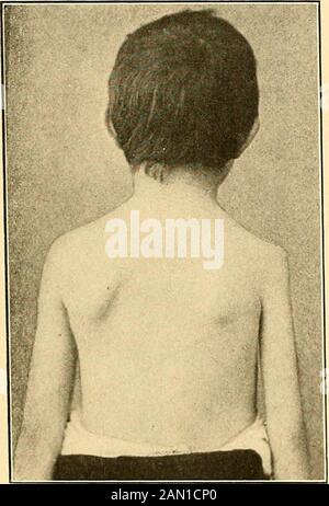 Diagnostic et traitement modernes des maladies de l'enfant; un traité sur les maladies médicales et chirurgicales de l'enfance anf . -spinal .Meningitis/ page 335 I. ( De Temps En Temps, cependant, l'inflam-mation est limitée aux membranes rachidiennes, comme l'hémorragie spinale, produite par le traumatisme. Les symptômes de la méningite spinale sont pratiquement les mêmes asrigidité et u hémorragie Spinale, sauf que l'affection antérieure est marquée paralysie. « o • r par une forte augmentation de la température au début et par un caractère moréprogressif des symptômes. La récupération est exceptionnelle.Le traitement est symptomatique Banque D'Images
