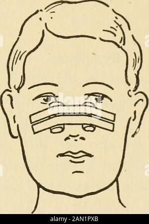 Le conseiller médical à domicile, un travail populaire sur le traitement de la maladie . ts, si les nasalbones sont fracturés. Si la déformation est grande, il y a des malformations, une fracture. Traitement.—la restauration du nez en forme normale est une tâche difficile ou impossible. Il y a toutes sortes de pieances ingénieuses ap à cette fin, dont aucune n'est totalement satisfaisante. Les services d'un chirurgien devraient être obtenus al-ways, si possible. Il lui sera nécessaire d'étheriser l'ordre patientin pour restaurer l'anatomie interne du septum. Le traitement le plus simple est celui de Davishet on se presse Banque D'Images