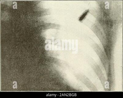 Blessures par balle : comment elles sont infligées : leurs complications et leur traitement . Fig. 44.—Skiagram montrant une balle de fusil turque déposée. Fig. 45.—Skiagram montrant une balle de fusil turc déposée dans le poumon droit. LÉSIONS CARACTÉRISTIQUES CAUSÉES PAR DES PROJECTILES 67 Banque D'Images