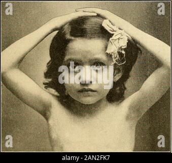 Diagnostic et traitement modernes des maladies de l'enfant; un traité sur les maladies médicales et chirurgicales de l'enfance anf . commencement, mais au fur et à mesure que la maladie progresse theymontrent une tendance marquée à subir la caséation et la suppuration.Fistuia> En outre, après l'évacuation du pus qui habituellement contiinstubercle bacilles, ils rarement cicatrize, mais, au contraire, continueas pus-décharge fistulae ou des ulcères indolent. Le cours de la maladie dépend beaucoup de la vitalitédu patient et du mode de traitement. Il est toujours chronique.enfants enlevés de l'environnement obnoxieux Banque D'Images