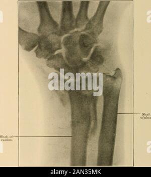 Le traitement des fractures . fig. 305.—fracture des colles, avec fracture à l'extrémité inférieure de l'ulna (tracé des rayons X). Le rayon Rontgen détermine le siège exact de la lésion. La mobilité et le crépitus AB-normaux sont facilement obtenus sans administration d'un anesthésique. Une séparation de l'Épiphyse inférieure du rayon : l'épiphyse inférieure du rayon s'unit à l'arbre d'environ. Fig. 306.—Cas : Adulte. Très grande résolution de l'extrémité inférieure du rayon. Extremelydifficile de mouler des fragments en bonnes positions. Noter l'enlèvement de la main. Lésions ASSOCIÉES À LA FRACTURE des colles 231 la vingtième année. Le rayonnement Banque D'Images