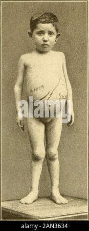 Diagnostic et traitement modernes des maladies de l'enfant; un traité sur les maladies médicales et chirurgicales de l'enfance anf . e ancienne variété. C'est une affection progressive et incurable de l'étiologie inconnue. 232 MALADIES DU FOIE. XO alco-holique stimulu-lants. Traitement.—Comme de petites quantités de liqueurs spiritueuses se sont avérées être la cause de très quelques cas de cir-rhose hypertrophique du foie chez les enfants, il est essentiel d'interdire son utilisation chez les enfants, sauf s'il est destiné à des fins thérapeutiques temporaires. Les iodures et mercurydevraient-ils avoir fait un essai équitable dans les allures de cirrhose irres Banque D'Images