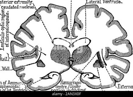 Des conférences sur la localisation des maladies du cerveau, données à la Faculté de médecine, Paris, 1875 . distinction.Nous avons déjà dit que les symptômes diffèrent en fonction de la portion de la capsule interne affectée par la lésion. Si elle occupe une partie des deux tiers antérieurs du thecapsule, la région où le tractus blanc sépare l'extrémité ante-rior du ganglion lenticulaire de la tête du ganglion théadaté, et qui appartiennent, comme vous le savez, au champ de l'artère létulo striée, h& paralysie sera ex-indice que le mouvement oi ; il n'y aura pas de tr durable