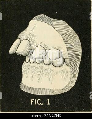 Transactions de la Illinois State Dental Society, 1892 . Et tridimensionnel. Parce que je suis capable de vous tosoter, dans les modèles de plâtre, le changement complet des dents, des mâchoires et de l'expression faciale, avec l'appareil qui a été porté en fait, avec une légère variation, du début à la comple-tion de l'opération. Le cas est l'une des jeunes filles de 13 ans^ quand il a commencé, et 16 ans quand il a terminé. En examinant les modèles il sera vu que la difficulté n'a pas été tant en raison de la protubérance marquée de la teethtransactionsofil28illi supérieure. 89 Banque D'Images