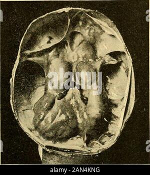 Trattato delle malattie mentali . Fig. 11. — Idrocefalo interno senza macrocefalia : ilbambino visse sino alletà di undici mesi ; morì perpolmonite; in vita la testa lasciava traspartire la luceduna candela perchè il cervello era ridotto ad unasottilissima lamella parietale, Venez vesi de gseguura-fi. Il SUBSTRATO ANATOMO-PATOLOG1CO DELLE MALATTIE MENTALI 67 che a sua volta rappresenta il postumo duna meningiite acuta (Quinke).Lidrocefalo infiammatorio forma in cronica è spesso la conseguenza diuna obliterazione delle comunicazionazioni ordinarie le trazazi strazazi spitazi sgilazi à la sparitazi Banque D'Images