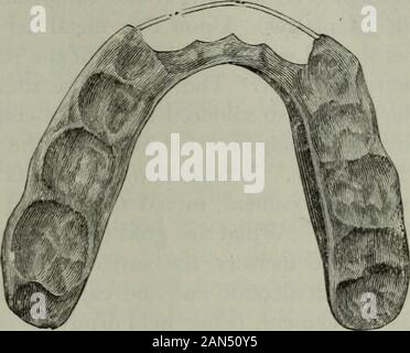 Le cosmos dentaire . ticable ce luminaire, quelque peu l'onu-confortable pendant la mastication, a été remplacé par une plaque inférieure, couvrir-ing les molaires, passant à travers les surfaces linguales des oralteeth et renforcé par un demi-tour sur le fil d'or platiné passant *à faire de moulages de plâtre de très longues dents, un morceau de bois d'hickory-orbamboo placés dans l'impression de la dent avant que le plâtre est coulé willprevent la rupture de la dent lorsqu'il est retiré de l'impression. Les dents à mouvement alternatif. Une étude. J053 sur les surfaces des dents incisives et cuspids. La partie supérieure de sur-f Banque D'Images