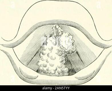 Saint Louis Medical and Surgical Journal . enfoncé et il a été incapable de pro- 226 communications originales. duce un ton au-dessus d'un chuchotement. L'aspect général d'thepatient était celui d'une personne, plus tard dans la phtisie  ; il était très émacié, avec ses pouvoirs corporels paire-im-grandement le moindre effort produisant une grande détresse et fa-tigue. Il a déclaré, que sept ans auparavant, il avait remarqué un alter-ation dans le ton de sa voix, et depuis ce temps, un graduallyincreasing enrouement enrouement ou jusqu'à ce que le ton était complètement dés-apparu. C'est seulement sur le début de la y Banque D'Images