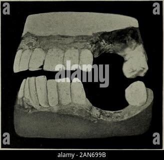 Le cosmos dentaire . Cas IV. Côté droit avant le traitement Fig. 14.. Cas IV. Côté gauche avant le traitement. abandonné, ainsi que le coin supérieur droit et des orientations générales de traitement comme tobicuspids et première molaire. De façon souple ont été la vie avait été donné, le patient wasthe dents de la mâchoire inférieure qu'aucune tentative n'a envoyé à la montagne pendant deux mois. Blanche.-ME TRAITER XT DE PYORRHÉE UN LVEOLARIS. 259 à son retour, j'ai été ravie de trouver racine de la deuxième molaire était par calcul de dents qui avaient été laissés dans l'époque une filiale, seules et l'extrémité distale Fig. 15. Banque D'Images