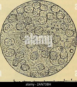 Principes du charpentier de la physiologie humaine . 4000 ll Fig. 100.-section transversale par aninjected le lobule du thymus chez l'enfant.-a, de l'investissement membraneux lobule;h, membrane de la glande-granulés ; c,cavité du lobule, à partir de laquelle la direction générale de l'largervessels-out. Fig. 101.-Thymus-jus riche en globules, avec quelques moleculesand secondaire le granularbase minutieusement sans structure. ainsi que pour le tissu conjonctif du septa très butvery compact réseau délicate est étendue, principalement formé par le anastomosingbranches multipolaire de cellules, dans les interstices de laquelle sont nu Banque D'Images