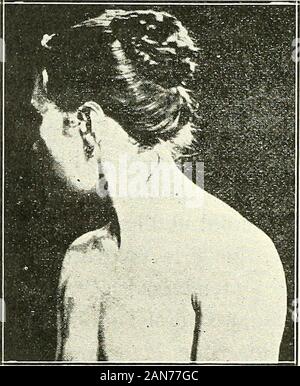 Traité des torticolis spasmodiques, spasmes, tics, rythmies du cou, torticolis mental, etc. . FiG. lis. KoUarits, en effet, dans son mémoire reported six ar, donttrois sont dus à Jendrassik : ou, sur ces six cas, un seul est. .---- %,:K-:j&^ Banque D'Images