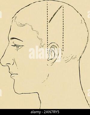 Le traitement des fractures . ,Une ligne tirée perpendiculairement à elle entrera dans la ligne une ti à peu près à l'emplacement de l'artère. Aline fonctionnant à partir de l'avant de l'apophyse mastoïde perpendiculaire à la ligne b c croise un d au plus sur the site de la direction générale postérieure. Dans la rupture de la base avec des symptômes prononcés, drainageof Le fossa impliqués, que ce soit en avant, au milieu ou en arrière,doit être envisagée. Il a parfois été de service. Pistolet-SHOT BLESSURES DU CRÂNE 37.-Pronostic Le pronostic du chef-blessures est le prognosisof leurs complications et séquelles. Inconscient prolongée-ness n'est pas u Banque D'Images