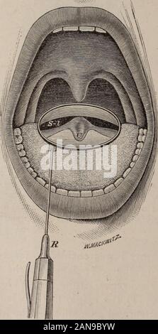 Revue médicale de Chicago et de l'examinateur . en haut orposterior surface du palais mou, et la proéminence orridge sur elle que la veine azygos uvulae forme (Fig. 2, Az-Pr thebase), de la langue maternelle (T), de l'épiglotte (EP), et le larynx, au moment de la tentative de la phonation du son a83, avec la bouche fermée. Mes observations sur ce patient est poursuivi dans un periodof cinq semaines. Par la suite, j'ai fait de nombreuses observations * Med Dunglinsons. Mourir. 238 Revue Médicale de Chicago et de l'examinateur. de caractère analogue sur six autres patients, qui hadlost le septum nasi, mais avait soft parfait Banque D'Images