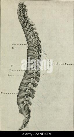 Principes et pratique de l'ajustement de la moelle épinière ; à l'usage des étudiants et des praticiens . Fig. 39. PosTEUioR Aspect de colonne vertébrale. (A) le déplacement latéral de la deuxième vertèbre dorsale vers la gauche. (B) déplacement latéral de la huitième vertèbre dorsale à droite. (C) la compression du côté gauche du disque entre la douzième vertèbre lombaire dorsale andfirst ce qui se traduit par un basculement de la douzième dorsale. (D) déplacement inférieur de la troisième vertèbre lombaire due à tliinninj ; la partie postérieure du disque entre elle et la quatrième vertèbre lombaire. MAL-ALTGNMENT 177 vertébrale. Fig. 40. Lat Banque D'Images