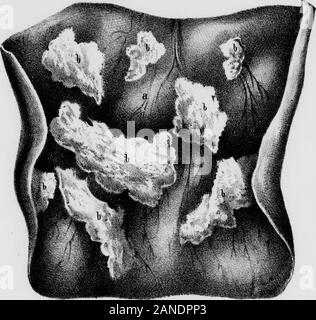 Observations pratiques sur certaines des maladies du rectum, l'anus, et textures contigus : donner à leur nature, siège, causes, symptômes, conséquences, et la prévention, notamment adressée à l'reader . rSfii. Un bras,£ pour baD& il byb. Qrin.ee de trie llxxsc TheEose ,c..d.Stajj Cocke.un Pad lo empêcher de xetarti Ike Hud.r,I.HcchimlJipe . Un porii.00. d.le rectum mis op en. Vy4 a. JaieimL snnzfeice o£ Tectum Ike. Ulcere ou : flie rectum . L'ULCÉRATION du rectum. 199 blush inflammatoire. Lorsque les ulcères sont situés dans theanal canal, dans les limites des sphincters, areexqu ils Banque D'Images