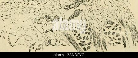 L'anatomie humaine, y compris la structure et le développement et des considérations pratiques . Les rejets de tunica pro-base ofpapilla pria constituant le tissu e-ofmembrane • stroma-T-fi^J--. ^^^f de tissu musculaire étant la langue de la Section de la muqueuse linguale, montrant filiformes papilles fongiformes. X 75. d'organes, ou les papilles, qui sont incorporés dans l'épithélium tapissant le grooveencircling l'élévation centrale. Une description détaillée de la les papilles est givenwith les organes de sens particulier (page 1433). La surface de la verticale tiers postérieur de la langue est lisse, dans l'sensethat il y a Banque D'Images