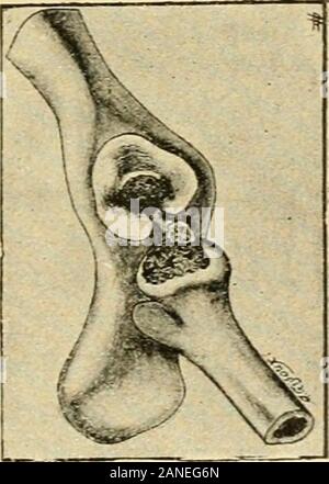 Sémiologie et diagnostic des maladies des animaux domestiques . aires, qui renferment à létat des élémentcellulaire normal peu distincte, se gonflent, les noyaux et volume augmententde deviennent vésiculeux, un nucléole en netapparail ; les cellules aplaties prennent une forme-leuse roumanie. A un moment donné, une capsule peut contenirplusieurs cellules ; mais bientôt chaque cellule sentouredune capsule secondaire. La formedîlots aflecte Cettemultiplication. Quand les divans profondessont atteintes, les lésions sont vi-sibles under the microscope : ellesconsistent soulèvementsdu in cartilage Banque D'Images