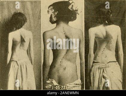 Courbure latérale de la colonne vertébrale et des épaules . Fig. 162.-fille âgée de 18 ans, après deux ans et demi de traitement par une série de mesures correctives ofPermanent vestes. Voir Fig. 161.-{J. Am. Med. Assn. ^ 19© de traitement. Fig. 163. Fig. 164. Fig. 165. Banque D'Images
