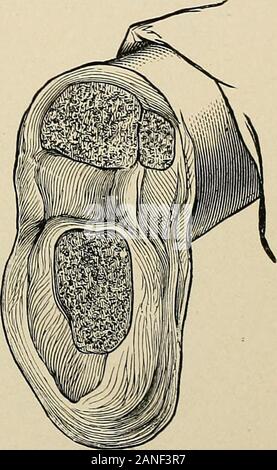La pratique de la chirurgie. Fig. 671.-incisions plantaires : A, Lis-franc ; B, C ; de Chopart, Pirogoff ; D,E ; Syme, Farabeufs subastragaloidamputation amputationat Farabeufs ; F, la cheville (Dennis). Fig. 672.-Pirogoffs:apparence amputation des articles après le removalof malleoli (Erichsen). tire son importance du fait qu'il a été le premier mis en osteoplasticoperation. Il date de 1854. Pirogoffs dans Symes ressemble à l'opération un grand nombre de ses caractéristiques. TheSyme incision est employée, et tous les os du pied sont removedexcept la partie postérieure de l'os calcis. Ce feuillet d'os est shap Banque D'Images