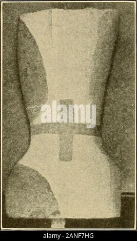 Courbure latérale de la colonne vertébrale et les épaules rondes si preferredrather . loid de plâtre, mais le plâtre est parfaitement efi-cace, althoughheavier. Objections à mécanique toutes les mesures correctives dans applyingforce-Jackets. pour corriger la courbe latérale et la rotation de la courbure scoliotique spine wecannot appliquer une telle force directement à la colonne vertébrale, mais nous devons appliquer la pression de thecorrective aux côtes. Les côtes sont lâchement attaché à thespine, et sont, de plus, plutôt facilement faussées par eux-mêmes pres- 176-traitement. Par conséquent, nous devons le faire sans que l'appHcation offorce direct à la structure touchée whic Banque D'Images