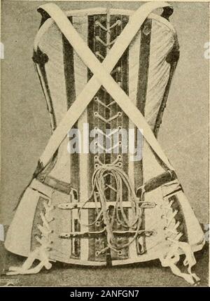 Courbure latérale de la colonne vertébrale et des épaules . Fig. 124.-pour la scoliose, cochon. 125.-pour la scoliose, Dos.-(Z. B. Adams.).-(L'Z. B. Adams.). Banque D'Images