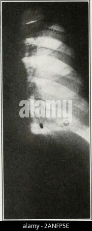 Peroral endoscopie et chirurgie laryngée . Fig 387a.-Bouton de la projection de l'axe rigide dans l'oesophage d'un nourrisson de2/2 mois. Esophagoscopy hy supprimé sans anesthésie. La lacération du esopli-agus a empêché le iUustrated hy méthode dans Fig. (209 auteurs) II.LrSTKAIIVE. cas de l'ENDOSCOPIE CAS 1-OK l-ilKKICN j;iil)li;s. 41 !). f k Banque D'Images