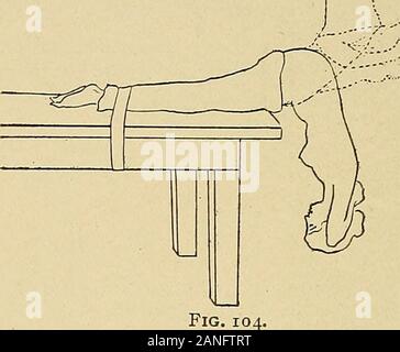 Courbure latérale de la colonne vertébrale et des épaules . Fig. 103. part contre l'arrière fermée, et, comme il hyperextends hisarms son tronc, s'étend vers l'arrière, l'extension de la force des coudes, et maintenir les mains jointes.Par cette modification l'épaule et scapulas-joints sont reportées et thehyperextension effectuée avec une amélioration de la position des épaules. C'est particu-lièrement adaptée pour arrondir les épaules. Banque D'Images