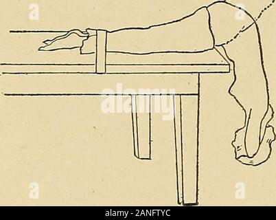 Courbure latérale de la colonne vertébrale et des épaules . Fig. 102. Traitement 144 tente. L'exercice peut être plus difficile en plaçant les mains derrière le neckand la quadrature les coudes en arrière ou en étendant les bras à côté de la tête, whichraises le centre de gravité (Fig. 99). Le ci-dessus peut être modifiée de la manière suivante : le patient fermoirs hishands derrière son dos au-dessus du niveau de la taille, en ligne avec les coudes fléchis et. Banque D'Images