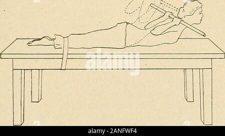Courbure latérale de la colonne vertébrale et des épaules . Fig. ioi. /.^ ? ?&gt ;A. Fig. 102. Traitement 144 tente. L'exercice peut être plus difficile en plaçant les mains derrière le neckand la quadrature les coudes en arrière ou en étendant les bras à côté de la tête, whichraises le centre de gravité (Fig. 99). Le ci-dessus peut être modifiée de la manière suivante : le patient fermoirs hishands derrière son dos au-dessus du niveau de la taille, en ligne avec les coudes fléchis et Banque D'Images
