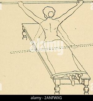 Courbure latérale de la colonne vertébrale et des épaules . Fig. 100.. Fig. ioi. /.^ ? ?&gt ;A Banque D'Images