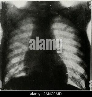 Peroral endoscopie et chirurgie laryngée . Fig. 371.-Radiographies, latérale et l'sliovving antéropostérieur, tack in loft mainbronclui ? D'un garçon de huit ans. Tack enlevé par bronchoscopie orale. withoutanesthesia (Radiographies par le Dr George C. Grier. Auteurs cas.) II.I.- USTKATIVl ; CASi:s KNDOSCOIV J-Lo- IORIUCN HODIIIS IIR. 405 Banque D'Images