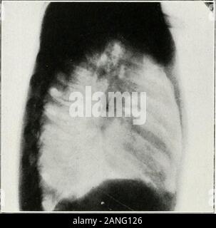 Peroral endoscopie et chirurgie laryngée . Fig. .--O^^raiilis.-Radio, anttro iostcrior latérale et|, montrant tack dans mainbrnnchiis gauche un iif lioy de dt-vcn ans. Tack enlevé par bronchoscopie orale witlnnit anes-thesia. (Radio.uraphs effectuée par le Dr George VV. plus sèches. Auteurs cas.^ LlSTRATlVU 404 Il.C.tr;s 111 IvMlOSCOPV nRKl j*IOR(;S liODIKS.. Banque D'Images