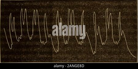 Les maladies du coeur et la circulation dans l'enfance et l'adolescence . iblepulse, marqué de la sorte dans cette maladie. Le pouls est soudain andbounding, donnant une impression d'apparente force, mais elle iselevated soudainement, et tombe immédiatement. Dans les mots, le ofCorrigan les troncs artériels de la tête, du cou, et upperlimbs à la fois attirer l'oeil par leurs propres pulsations ; ateach la diastole, sous-clavière, carotide, temporelle, andsometimes humérale même les artères palmaire sont projetés de force depuis 126 Keating et Edwards : Les maladies du Cœur leur lit et tenu sous la peau. Afin de mieux l'ob-serv Banque D'Images