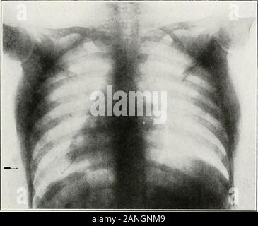 Peroral endoscopie et chirurgie laryngée . Fig. 197.-La radiographie de l'axe du chef hing d'une jeune fille, âgée de dix-huit ans.L'axe n'a pas pu être toimd bmnchoscopy à. (Mis ? C). Comment l'axe inférieur radiographshows avait migré vers la plèvre au bout de deux ans. Les cas d'BKONCIIOSCOPV infructueuse. 323. Banque D'Images