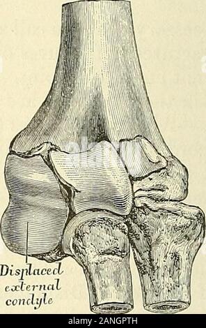 Un traité pratique sur les fractures et luxations . Fe- DisjrHaced ieocternaT&lt; !|Fracture du condyle condyle externe par l'intermédiaire de personnes déplacées avec dislocationthe condyle externe capitellum. du radius et du cubitus. (Bryant.) assumer lors de l'avant-bras est étendu. Il est même possible, quand thefracture traverse la trochlée, pour l'ulna aussi de devenir displacedbackward avec le rayon et le moindre fragment. (Fig. 132.)Crépitation, qui est habituellement très distinct, est plus facilement obtenu par tour-ing le rayon, ou par la saisie sur du condyle avec le pouce et les doigts, et de le déplacer vers l'arrière a Banque D'Images