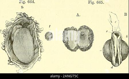 Éléments d'anatomie du Quain . 772 Les droits de l'UTEEOGESTATIOJSr yLth. ou d'un pouce. Pas de traces étaient n'importe où pour être détecté de anembryo ; mais la membrane de l'Avhich villositiessprang ovnm à partir de l'est de la structure cellulaire, et au milieu de la partie lisse,tourné vers l'utérus, il y avait un point opaque qui pourrait betaken pour l'embryon d'un salon, et qui a présenté à l'interne un thinlayer de cellules nucléées finement granulaire. L'ovmn jeter sur l'intérieur de la face postérieure de l'utérus près du bord supérieur, intégrés dans la muqueuse épaissie ou deciclua, et d'avoir une fine couvrant Banque D'Images