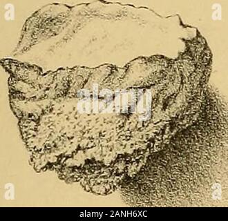 Les malformations, maladies et blessures des doigts et orteils et leur traitement chirurgical . 05. Les os des phalanges d'un doigt, la première phalange de qui a été affectée avec cario-nécrose. Le outertable de l'os s'est élargi, et en-fermé séquestres de cancellated la texture, . 145 106. L'articulation métacarpienne-phalangienne et premier os d'un doigt, montrant presque tout le destruction du dernier boneby ulcération cancéreuse, qui trouve son origine dans theskin de la main, ...... 147 107. Les os des phalanges d'un doigt, montrant cario- nécrose de la première phalange. La table externe de l'os de ce w Banque D'Images