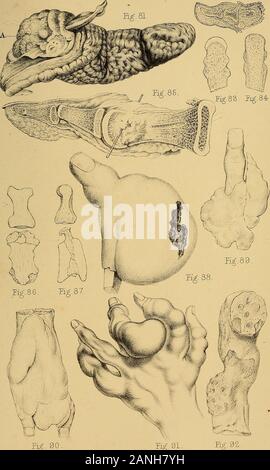 Les malformations, maladies et blessures des doigts et orteils et leur traitement chirurgical . h un des sinus dans le diseasedportion externe de l'os, ...... 129 86. L'articulation métacarpienne-phalangienne et premier os d'un pouce qui avait souffert d'inflammation chronique. Twonew les processus a été formé à l'extrémité distale de l'ex-tremity métacarpe avec lequel le firstphalanx, articulés . . . 139 [Traduction] 87. Section du même os montrant une forte augmentation de l'épaisseur de la couche compacte, et presque entireobliteration cancellated, texture de la . . 139 88. D'une tumeur cartilagineuse Banque D'Images