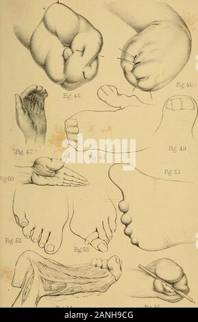 Les malformations, maladies et blessures des doigts et orteils et leur traitement chirurgical . jg. Page 45. Palmar surface d'une main dans laquelle il y a eu union congénitale et d'insuffisance des extrémités de tous les thedigits. Pièces, de baleine ont été passedthrough les fissures qui séparait la première pha-langes, ........ 47 46. Surface dorsale de la même main, . . .47 47. Union congénitale de tous les doigts, . . .51 48. Union congénitale de tous les doigts, avec une distorsion du pouce, 5049. Pouce surnuméraire de la quatrième gamme, ayant trois clous, ....... 35 50. Tumou fibro-cellulaire Banque D'Images