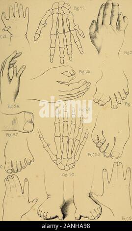 Les malformations, maladies et blessures des doigts et orteils et leur traitement chirurgical . numerary doigt de la première variété connectéau la balle du pouce, .... 22. Doigt surnuméraire de la deuxième variété articu- relative à l'os métacarpien du petit doigt,de Otto. . . . 23. Doigt surnuméraire de la deuxième variété articu- relative à la tête de l'os métacarpien de thelittle doigt, ...... 24. Pouce surnuméraire de la deuxième variété, 25. Pouce surnuméraire de la deuxième variété, 26. Gros orteil surnuméraire de la quatrième série, 27. Pouce surnuméraire de la Banque D'Images