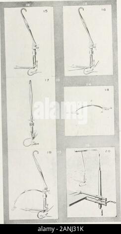 Peroral endoscopie et chirurgie laryngée . Fig. 100, loi, 102, 104, 105, 106, 107, 100, loS. no. Laryngoscopie DE SUSPENSION. 139. Fig. Mauvais à 116. 140 SUSPENSION LARYNGOSCOPIE. De la fin d'une série de détails ont été ajoutés. La langue-spatule doit être asimple instrument qui a une poignée pour attachmentto particulièrement formé la suspension-crochet, (m) Fig. 107 ; la surface supérieure qui est di-corrigées vers la langue est rugueuse (Fig. 107n), de façon à ce que la spatule willnot de glisser. Son extrémité antérieure est en forme de coeur après le modèle d'theReichert crochet pour soulever l'épiglotte (Fig. llJ). Sur la libre sur-face de la Banque D'Images