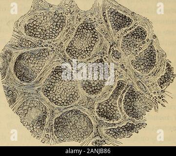 Un traité sur la pratique de la médecine, à l'usage des étudiants et des praticiens . Dans la description de l'lesionsof pulmonaire pneumonie catarrhale, il a été montré que les alvéoles des poumons arecrowded avec cellules, et que les bronchioles sont remplis d'yellowishmuco-pus. La partie qui l'épithélium des alvéoles se inthese changements est contestée. Selon Rindfleisch* ce pavementepithelium subit une desquamation et d'autres changements. Le cellsfirst devenir looser, leurs surfaces sont couvertes d'une thicklayer de protoplasme, finement granulaire au même moment dans chaque cellule la * Banque D'Images