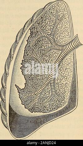 Un traité sur la pratique de la médecine, à l'usage des étudiants et praticiens . pleural argentin est présent, un élargissement du côté affecté est discerné ; les espaces inter-costal sont moins concaves, sont élevés à un niveau de la côtes, evenrise au-dessus d'eux, et aucun mouvement n'a lieu dans la respiration, tandis que côté thehealthy est anormalement actives. À la palpation, l'absence d'vocalfremitus est un symptôme très important et significatif. Le fremitusof la voix est moindre que l'épanchement s'élève, pour être tout à fait absent lorsquele poitrine est distendu. Sur le côté sonore du chant est exag fremitus-gerated. Quand Banque D'Images