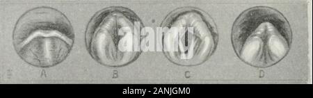 Peroral endoscopie et chirurgie laryngée . omy il est considéré avoir été une illu-sion. (Voir figures 6, SI et -ISS). 91 DIRKCT la laryngoscopie. L'étude de la mauvais image laryngoscopic direct il doit être rememberedthat ardoisere^-nx, comme le visage, est plein de muscles et est en train de changer son ex-pression chaque instant. Le laryngologist qui ébauches aussi précisément ashe peut remarquerez qu'il n'existe pas deux esquisses sont exactement semblables. Le authorhas été critiqué, par des étudiants qui n'ont pas compris cela, pour représentant soit la même l'épiglotte ou les mêmes larynx différemment à differenttimes. Ce n'est qu'en vertu de l'une plus profonde Banque D'Images